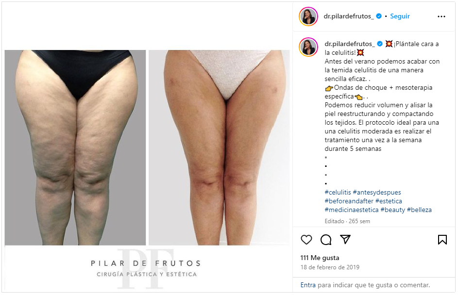 eliminar celulitis antes y despues