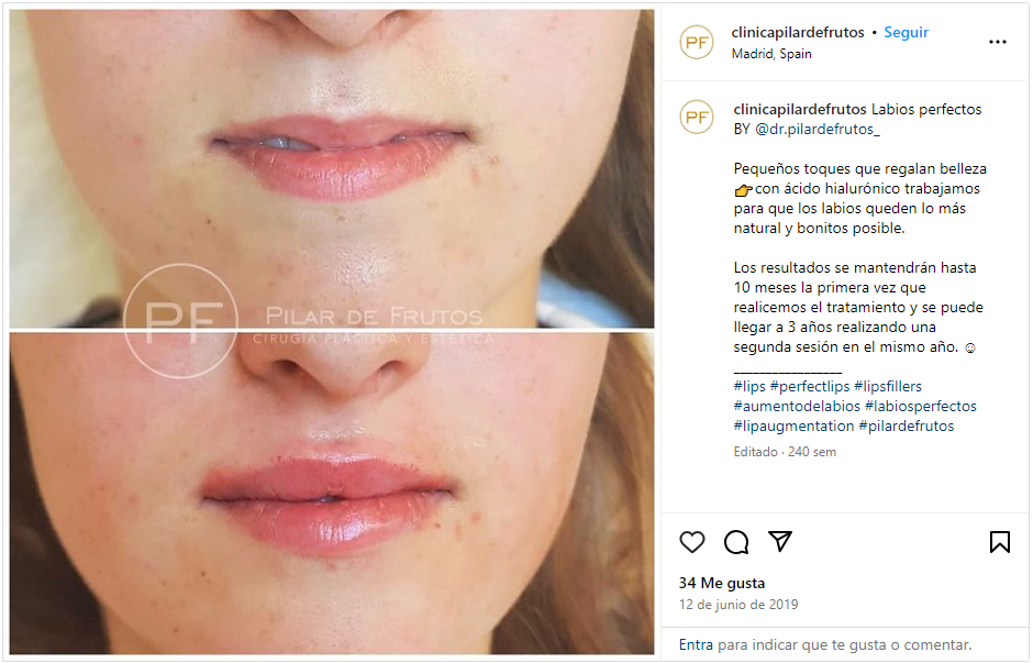 labios naturales y con volumen