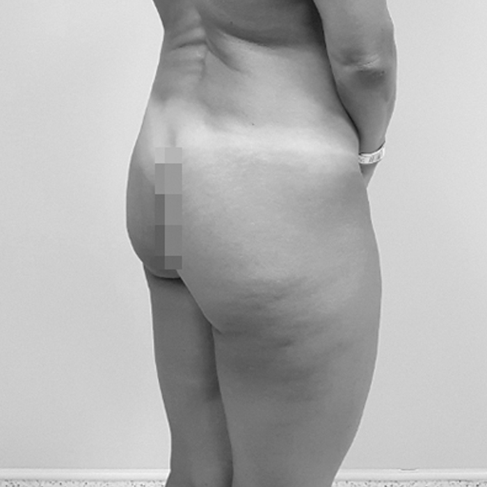 Fotos de Aumento de Glúteos por Lipotransferencia Antes y Después