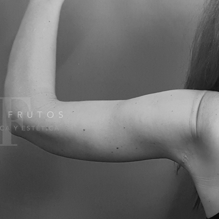 Fotos de Lifting Brazos y piernas antes y después