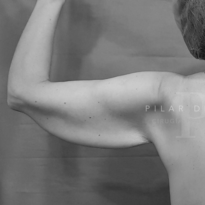 Fotos de Lifting Brazos y piernas antes y después