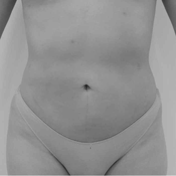 Lipo Vaser Lifting fotos antes y despues