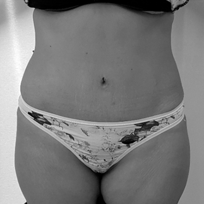 Fotos de Abdominoplastia Después