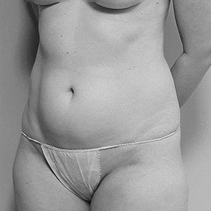 Diastasis Abdominal Flacidez