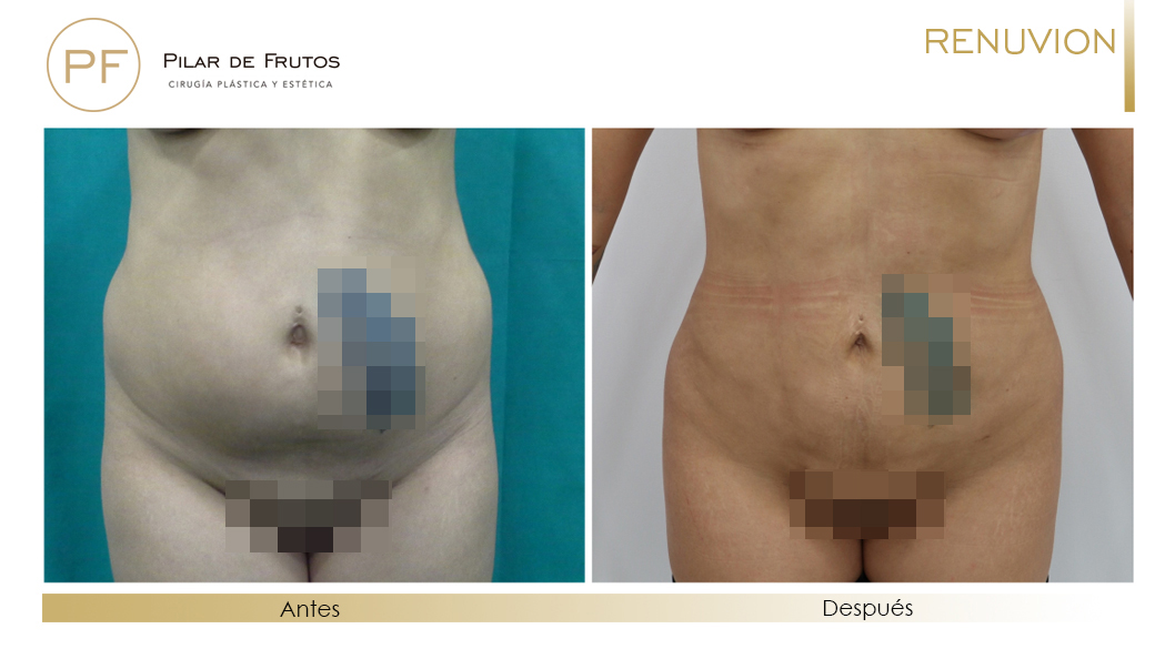Fotos de eliminar la flacidez con Renuvion J-Plasma antes y despues