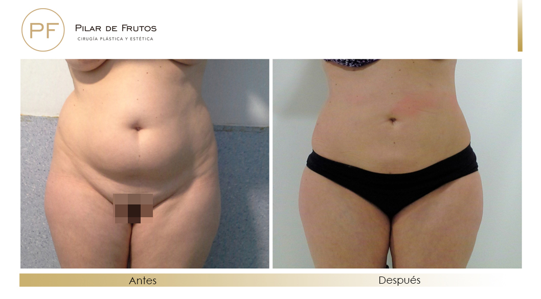 Fotos de eliminar la flacidez con Renuvion J-Plasma antes y despues