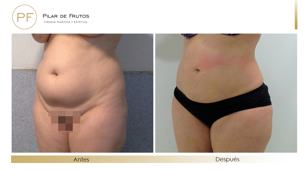 Fotos de eliminar la flacidez con Renuvion J-Plasma antes y despues