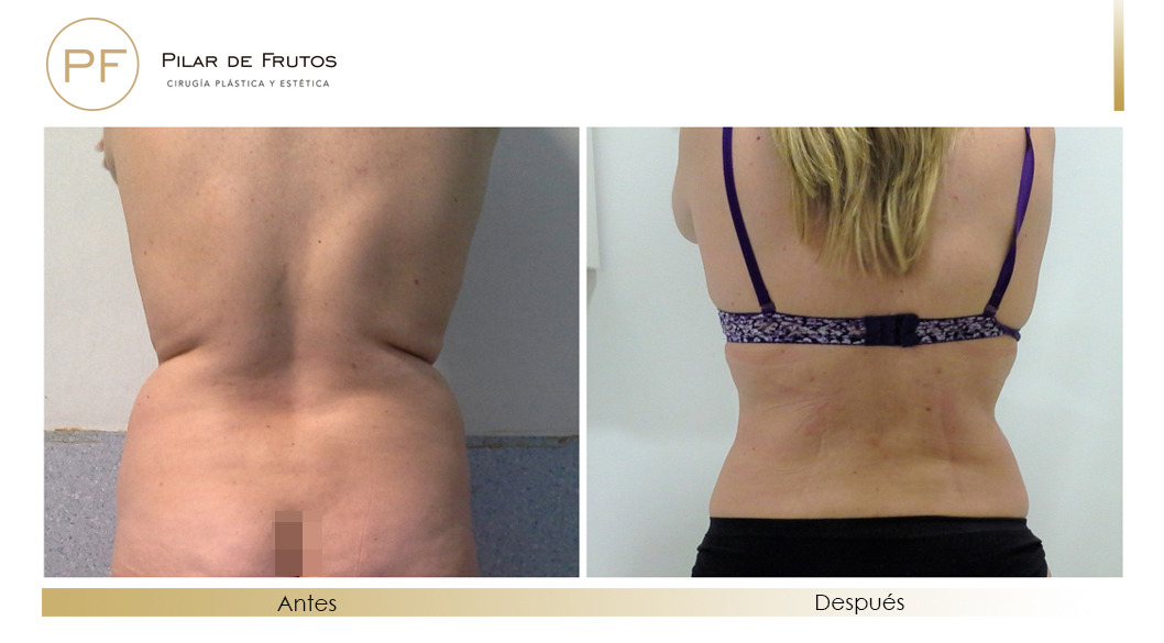 Fotos de eliminar la flacidez con Renuvion J-Plasma antes y despues