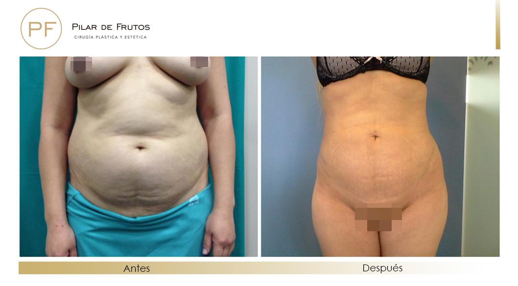 Fotos de eliminar la flacidez con Renuvion J-Plasma antes y despues