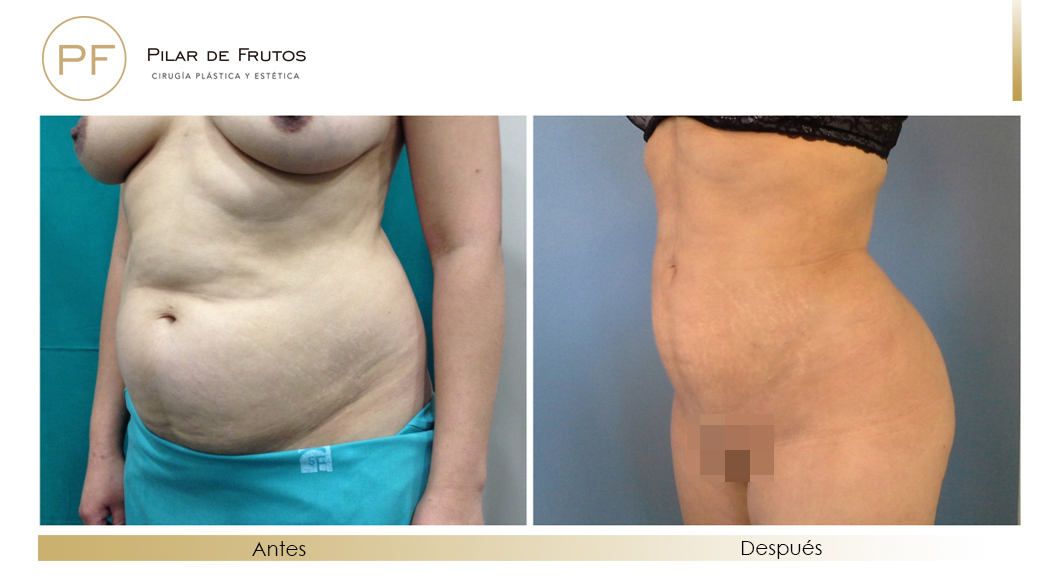 Fotos de eliminar la flacidez con Renuvion J-Plasma antes y despues