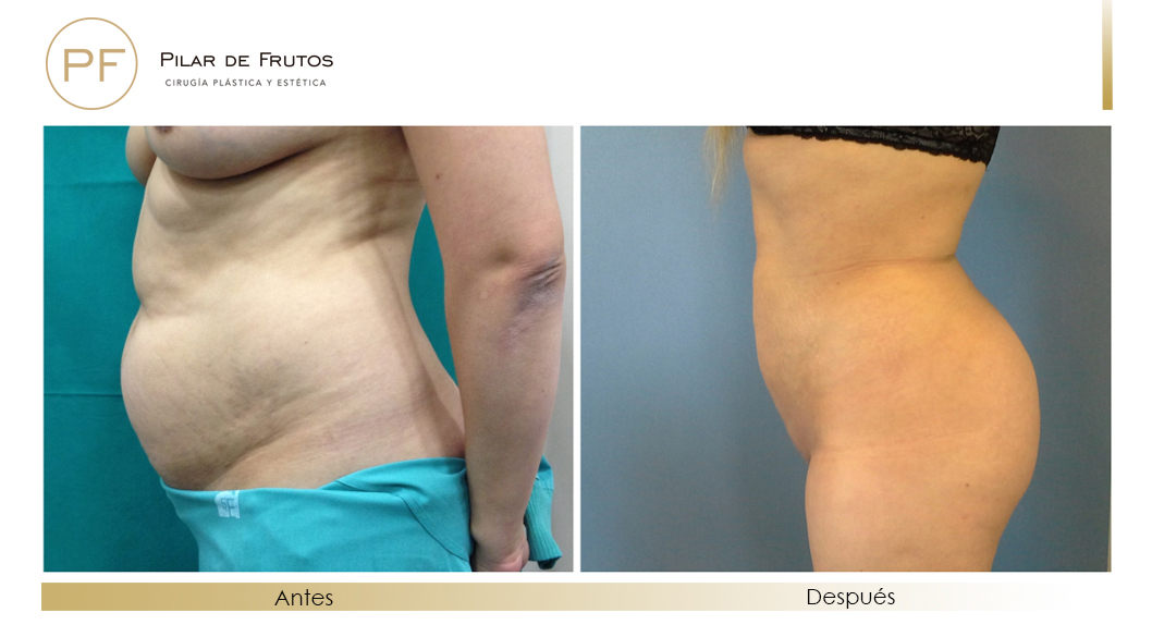 Fotos de eliminar la flacidez con Renuvion J-Plasma antes y despues