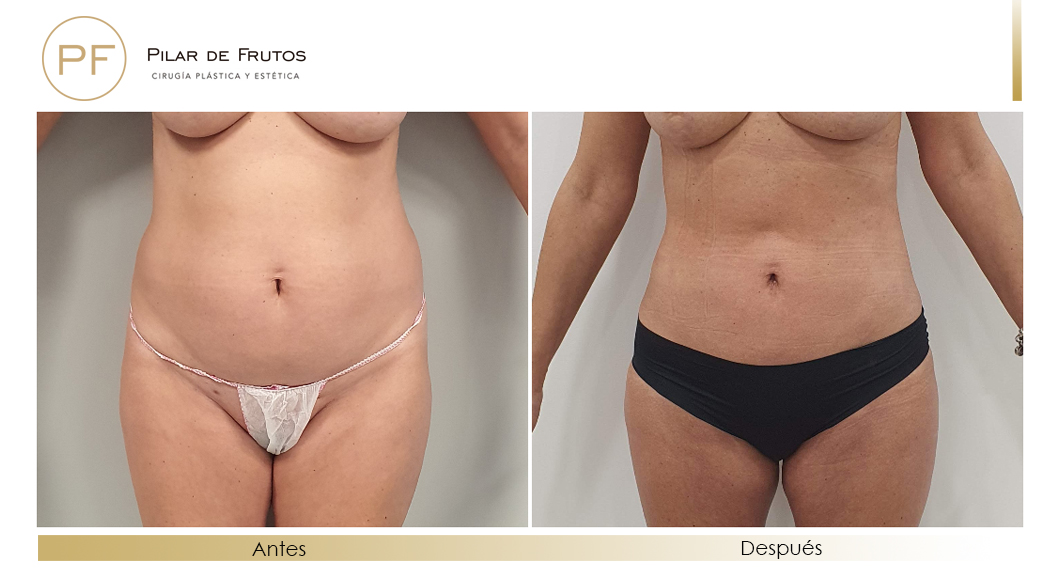 Fotos de eliminar la flacidez con Renuvion J-Plasma antes y despues