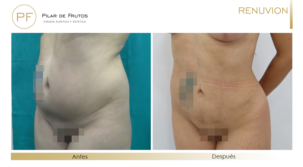 Fotos de eliminar la flacidez con Renuvion J-Plasma antes y despues