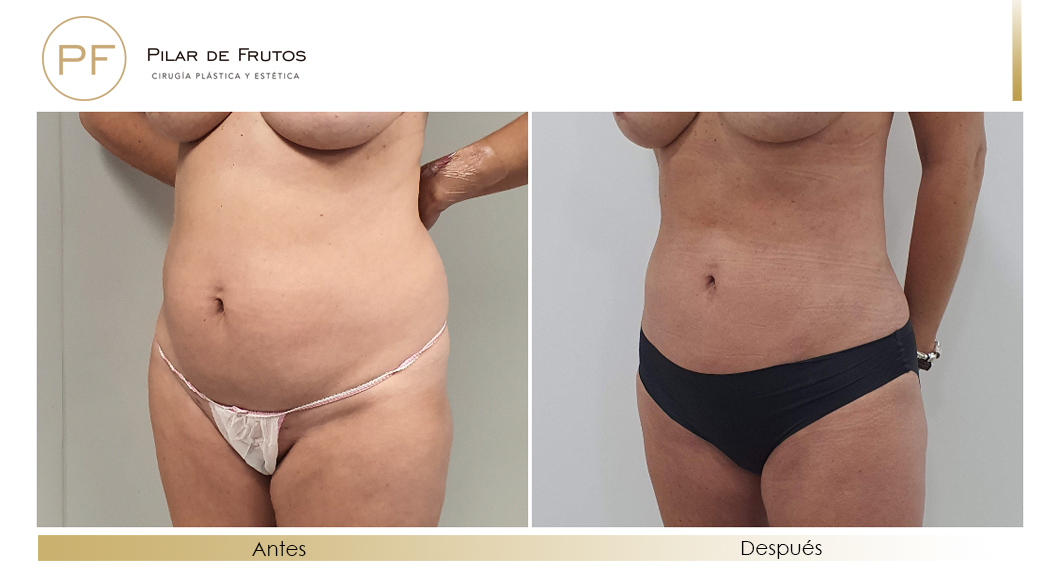 Fotos de eliminar la flacidez con Renuvion J-Plasma antes y despues