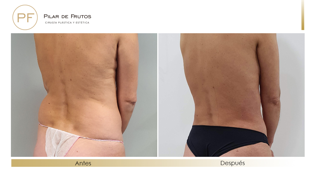 Fotos de eliminar la flacidez con Renuvion J-Plasma antes y despues