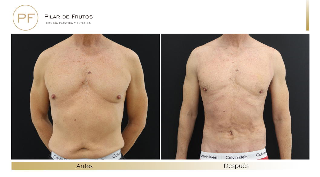 Fotos de eliminar la flacidez con Renuvion J-Plasma antes y despues