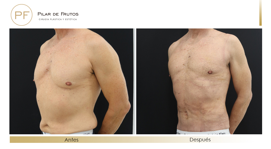 Fotos de eliminar la flacidez con Renuvion J-Plasma antes y despues