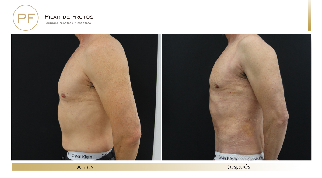 Fotos de eliminar la flacidez con Renuvion J-Plasma antes y despues
