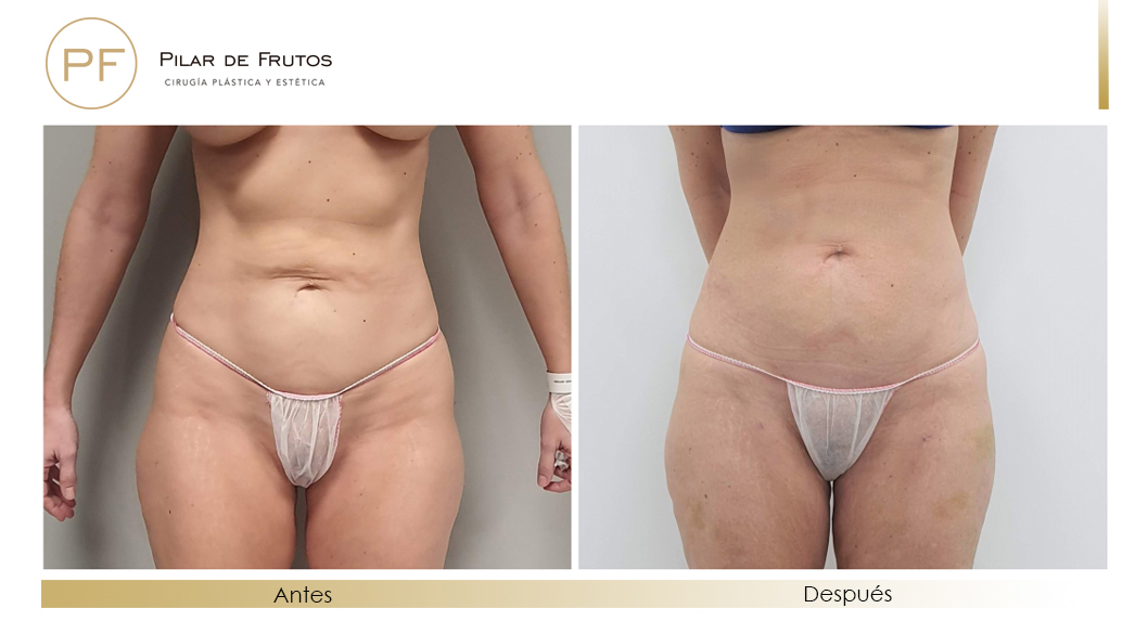 Fotos de eliminar la flacidez con Renuvion J-Plasma antes y despues