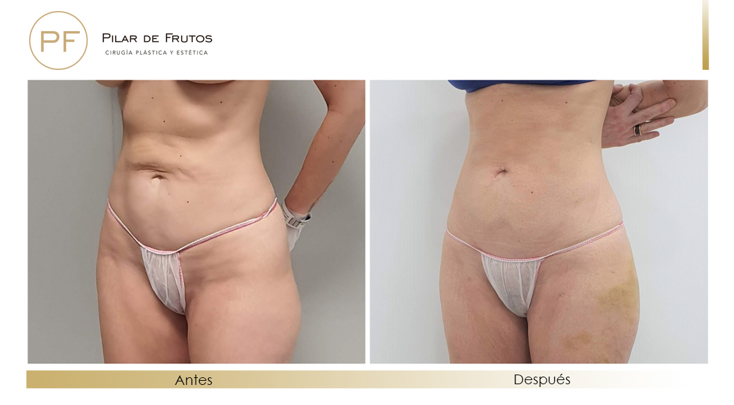 Fotos de eliminar la flacidez con Renuvion J-Plasma antes y despues