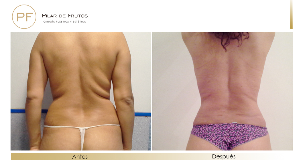 Fotos de eliminar la flacidez con Renuvion J-Plasma antes y despues