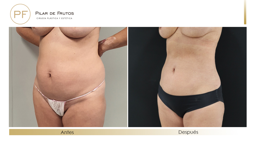 Fotos de eliminar la flacidez con Renuvion J-Plasma antes y despues