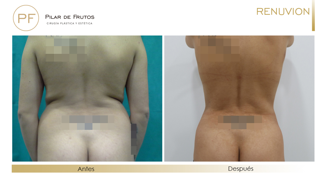 Fotos de eliminar la flacidez con Renuvion J-Plasma antes y despues