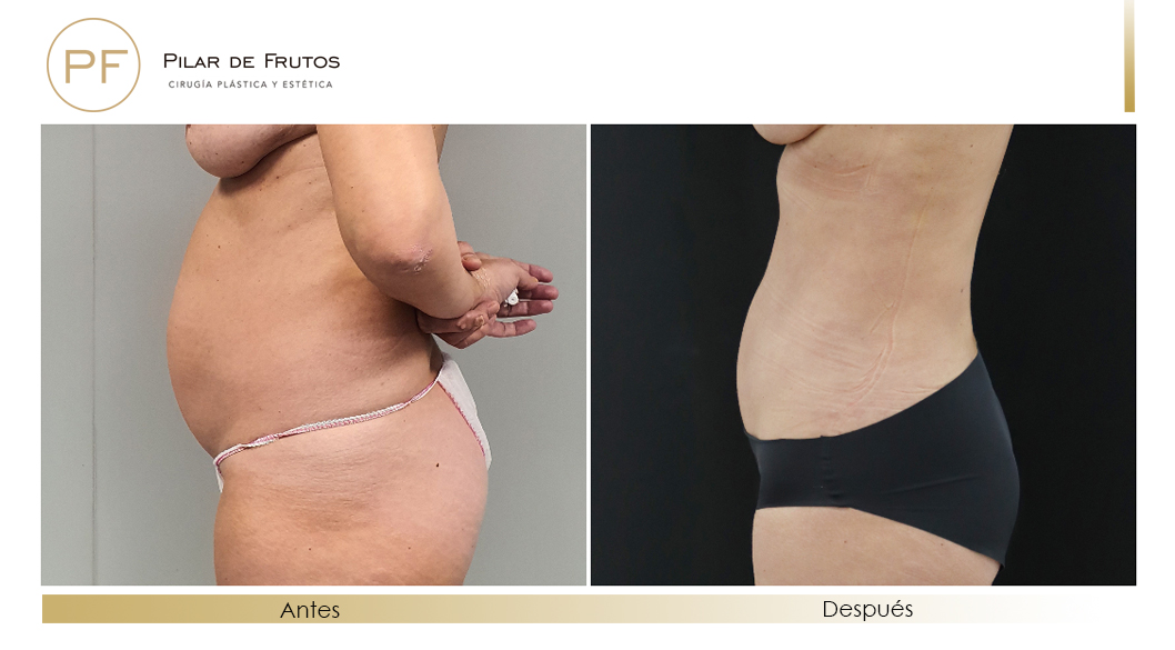 Fotos de eliminar la flacidez con Renuvion J-Plasma antes y despues