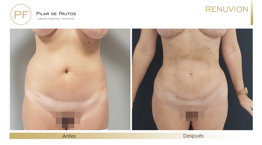 Fotos de eliminar la flacidez con Renuvion J-Plasma antes y despues