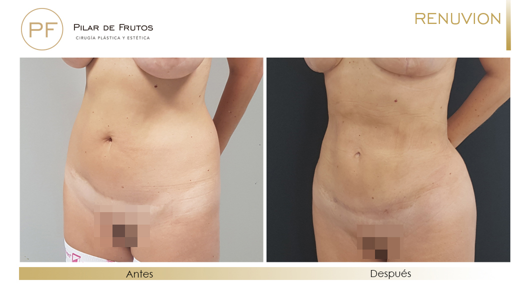 Fotos de eliminar la flacidez con Renuvion J-Plasma antes y despues