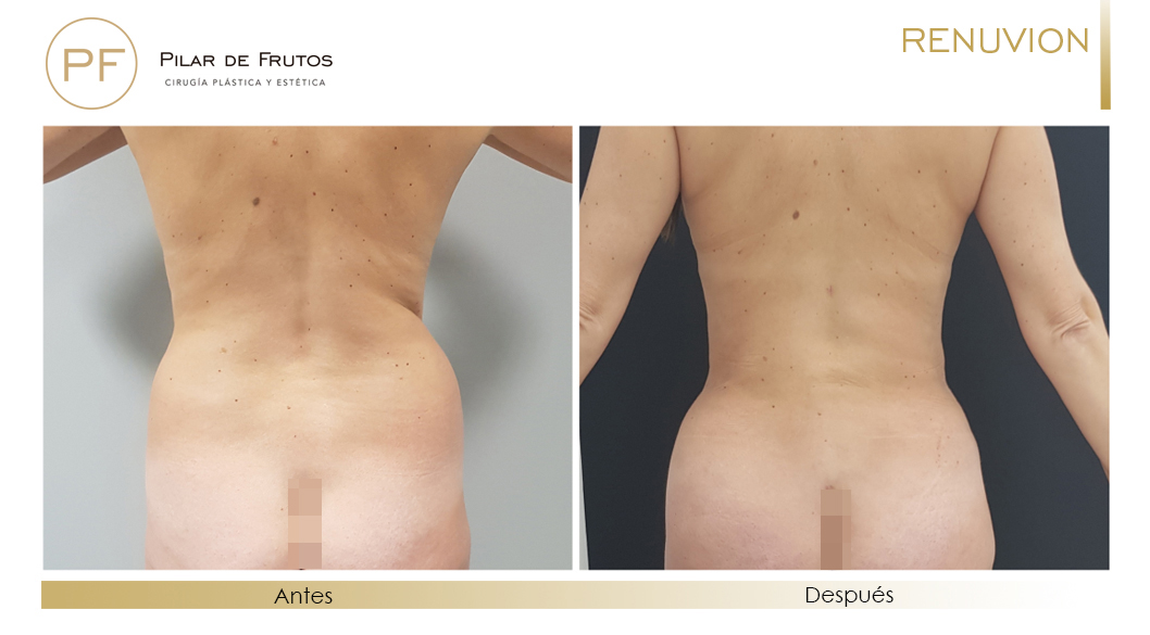 Fotos de eliminar la flacidez con Renuvion J-Plasma antes y despues