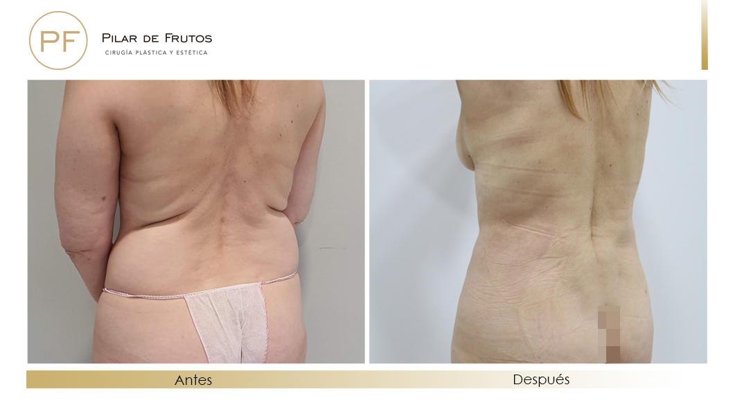 Fotos de eliminar la flacidez con Renuvion J-Plasma antes y despues
