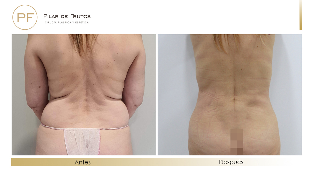 Fotos de eliminar la flacidez con Renuvion J-Plasma antes y despues