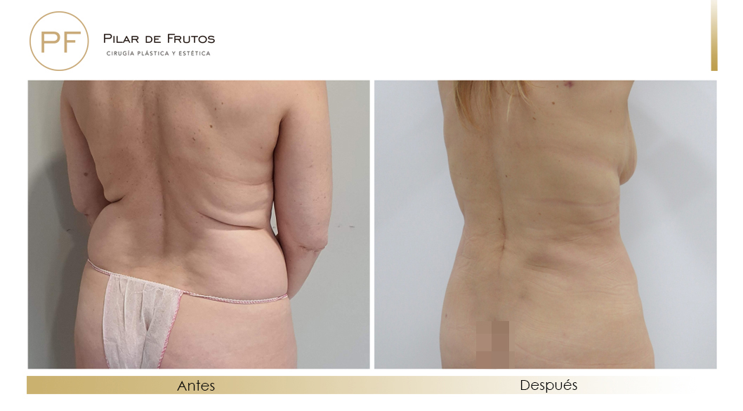 Fotos de eliminar la flacidez con Renuvion J-Plasma antes y despues