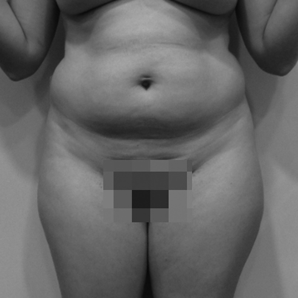 Body Tite Liposucción sin cirugía antes