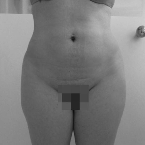 Body Tite Liposucción sin cirugía después