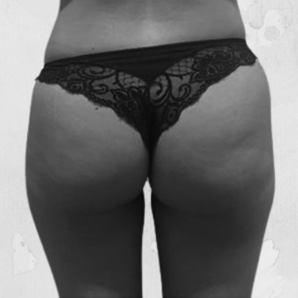 Fotos de Remodelacion de Glúteos Antes