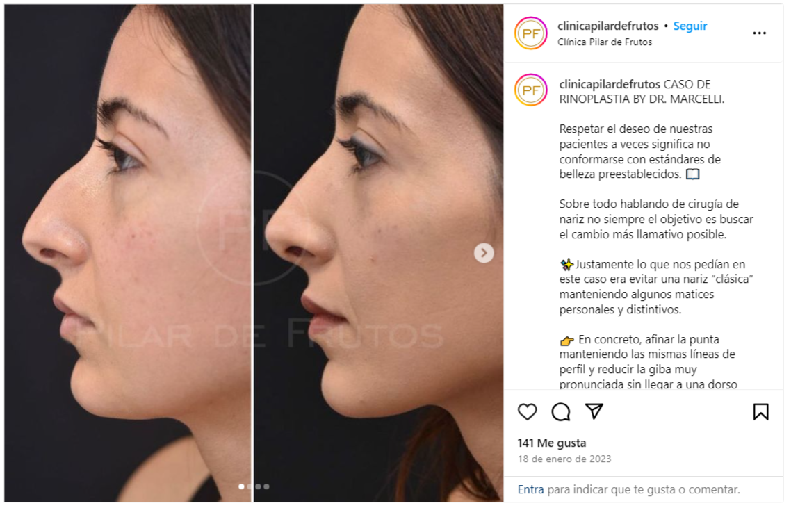 rinoplastia antes y despues