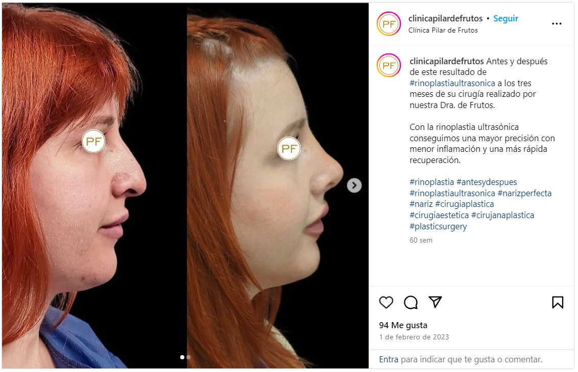 rinoplastia antes y despues